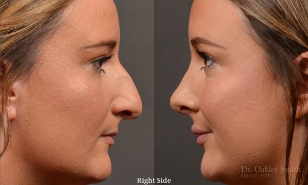 Rhinoplasty, Septoplasty - Rhinoplasty Before and After Case 478