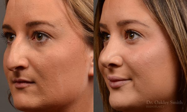 Rhinoplasty, Septoplasty - Rhinoplasty Before and After Case 478