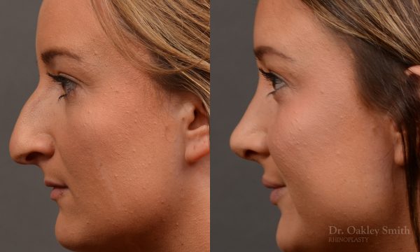 Rhinoplasty, Septoplasty - Rhinoplasty Before and After Case 478