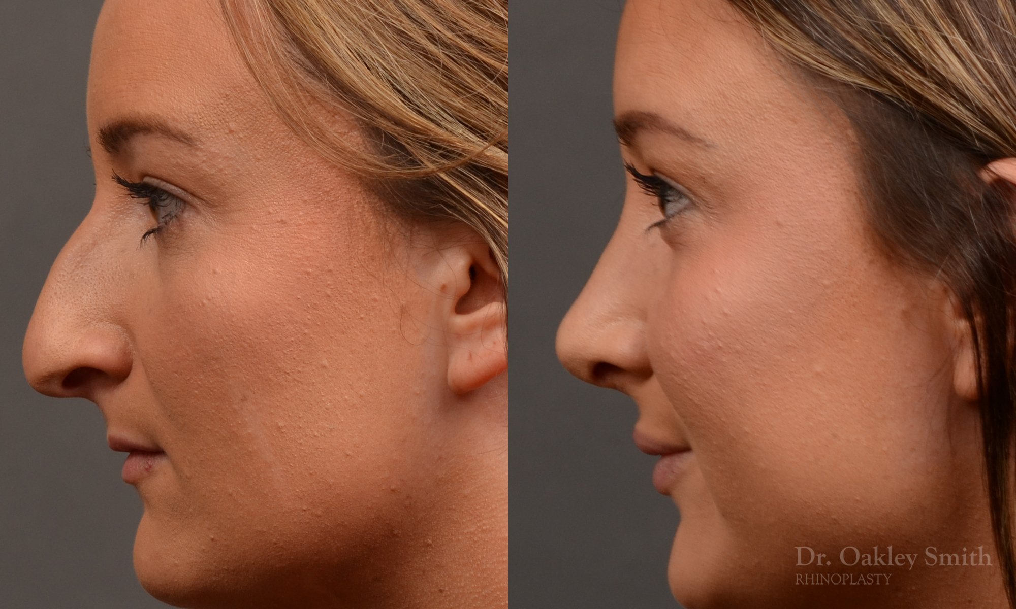 Rhinoplasty, Septoplasty - Rhinoplasty Before and After Case 478