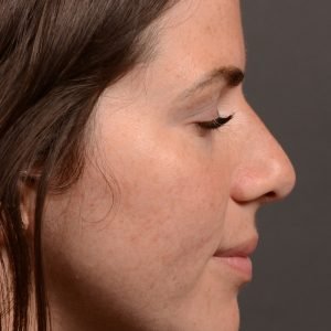 Rhinoplasty - Rhinoplasty Before and After Case 481