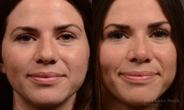Rhinoplasty - Rhinoplasty Before and After Case 481