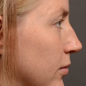Rhinoplasty - Rhinoplasty Before and After Case 482