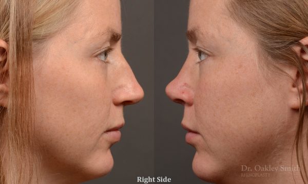 Rhinoplasty - Rhinoplasty Before and After Case 482