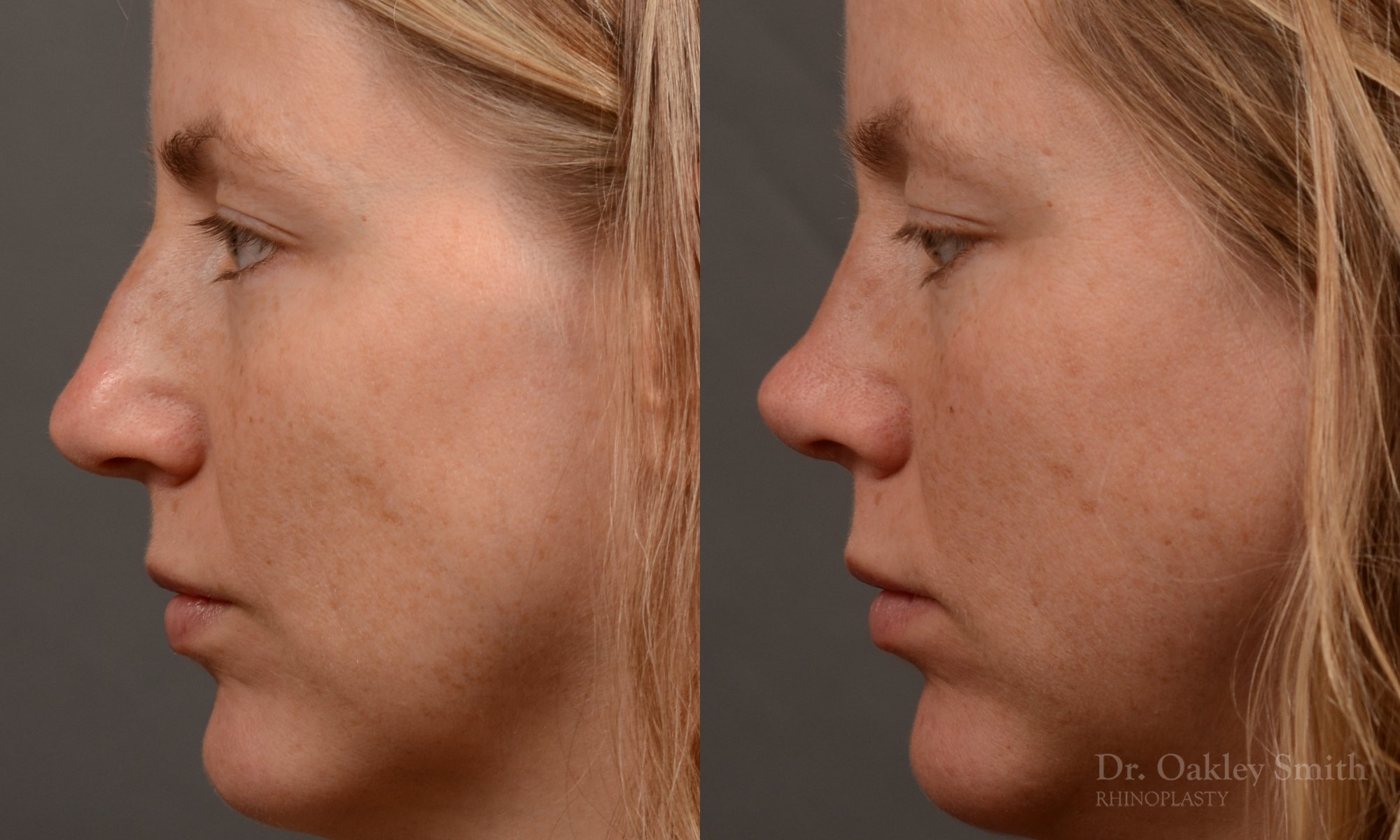 Rhinoplasty - Rhinoplasty Before and After Case 482