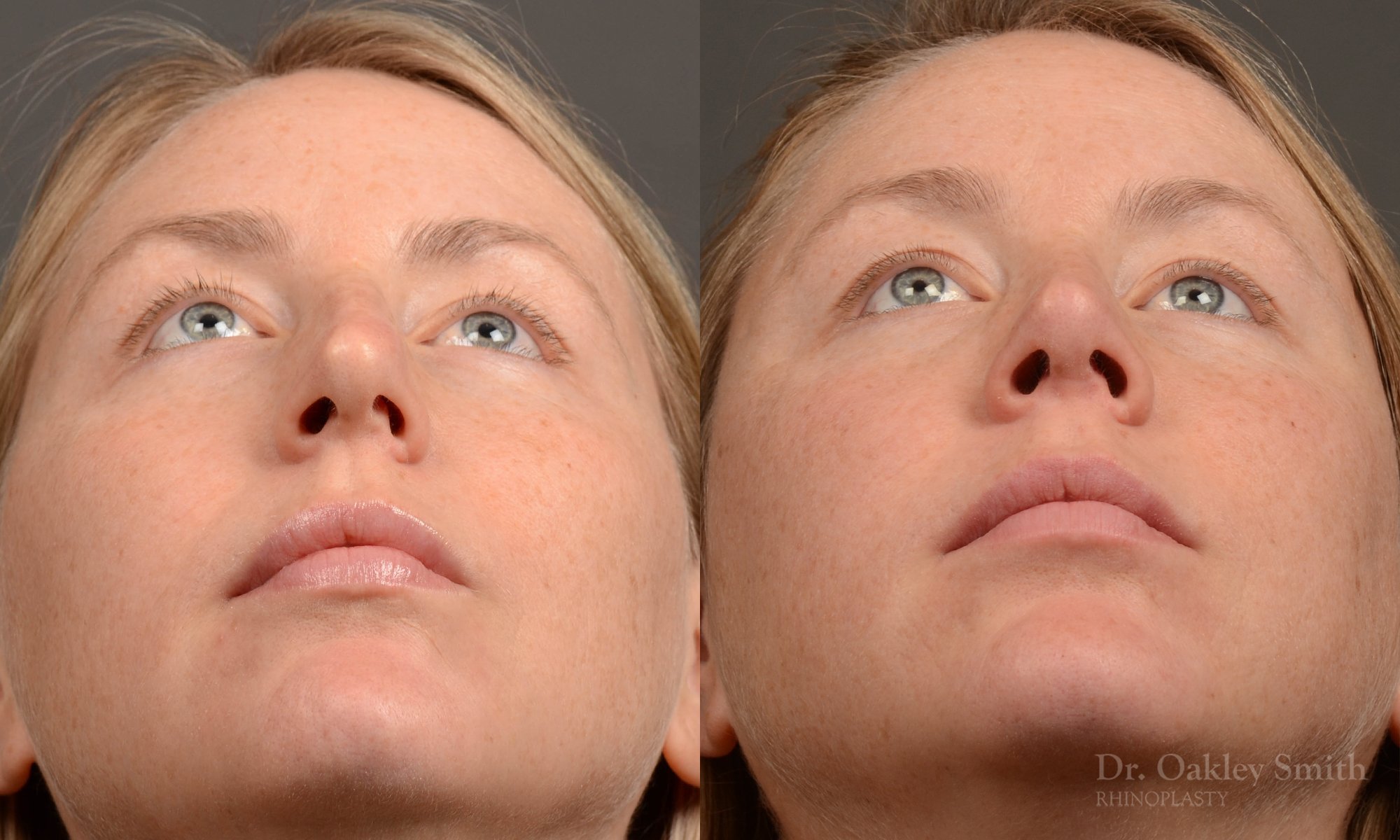 Rhinoplasty - Rhinoplasty Before and After Case 482