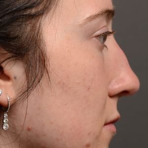 Rhinoplasty, Septoplasty - Rhinoplasty Before and After – Case 484