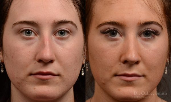 Rhinoplasty, Septoplasty - Rhinoplasty Before and After – Case 484