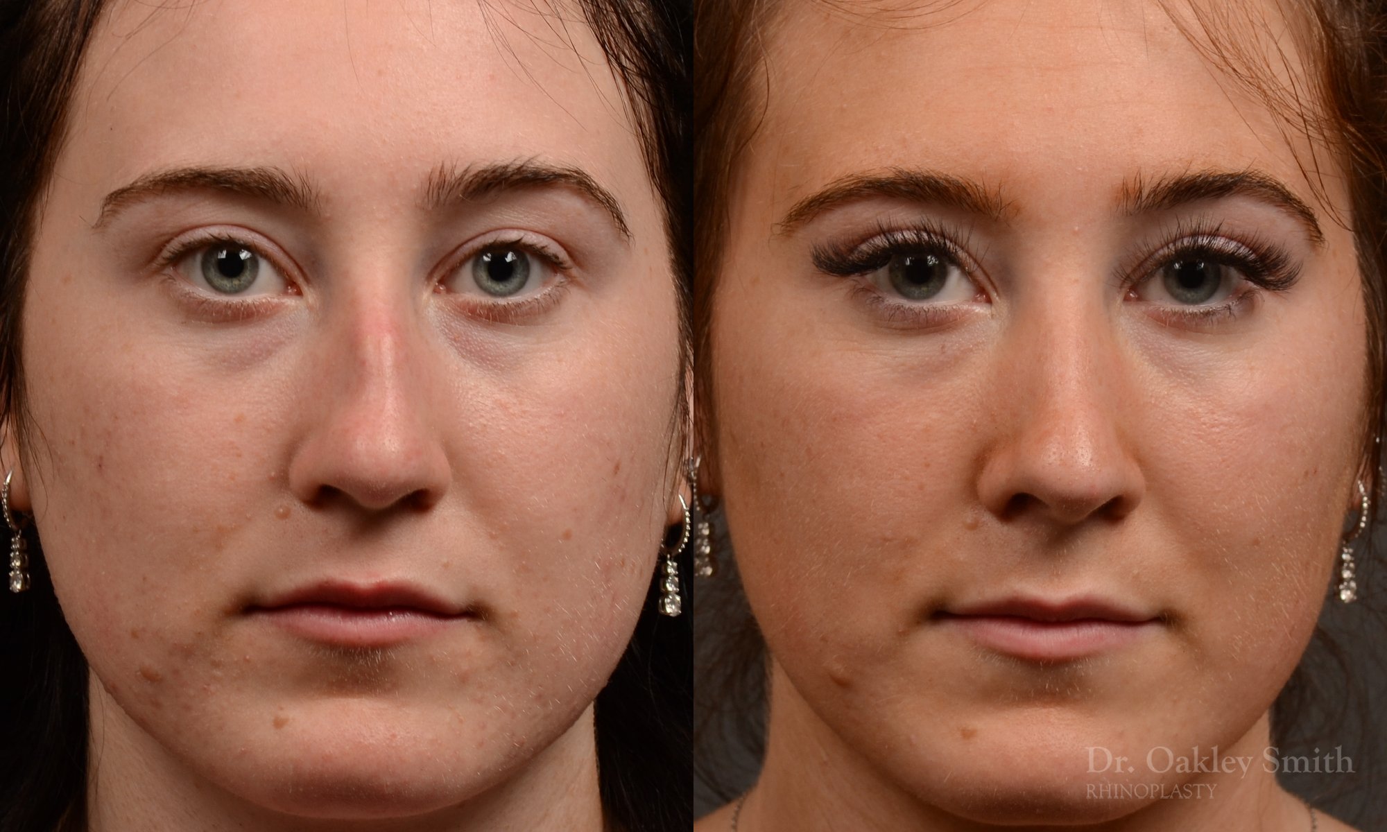 Rhinoplasty, Septoplasty - Rhinoplasty Before and After – Case 484