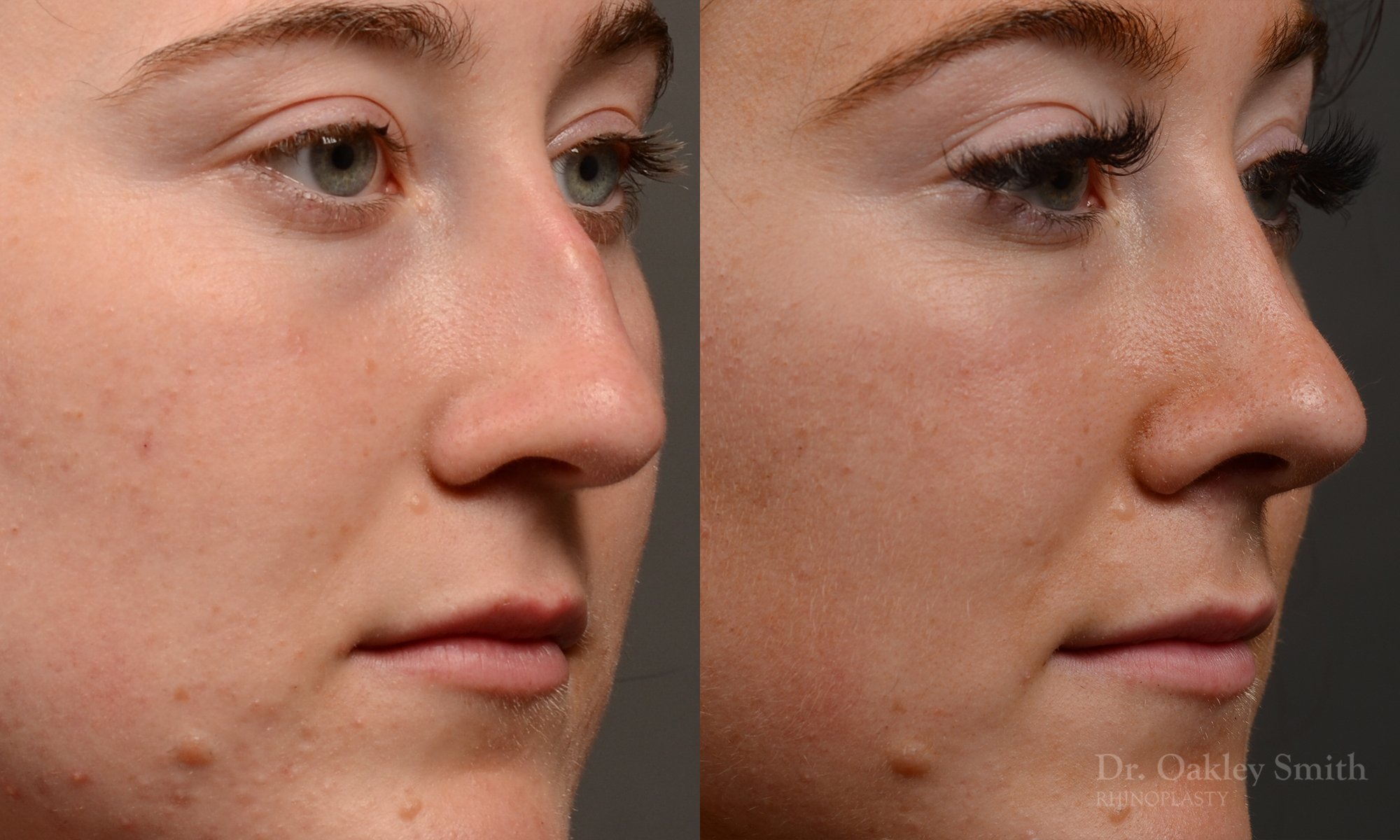 Rhinoplasty, Septoplasty - Rhinoplasty Before and After – Case 484