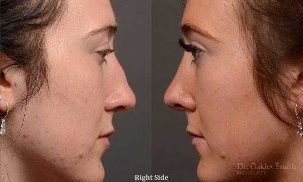 Rhinoplasty, Septoplasty - Rhinoplasty Before and After – Case 484