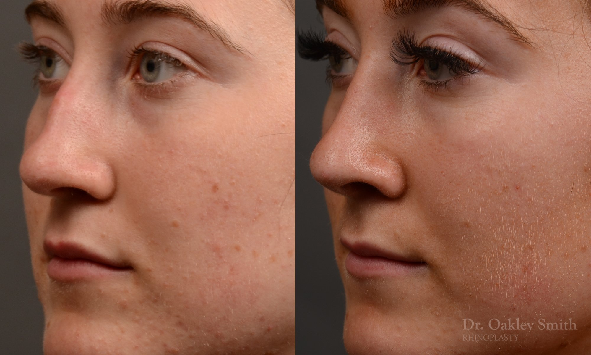 Rhinoplasty, Septoplasty - Rhinoplasty Before and After – Case 484