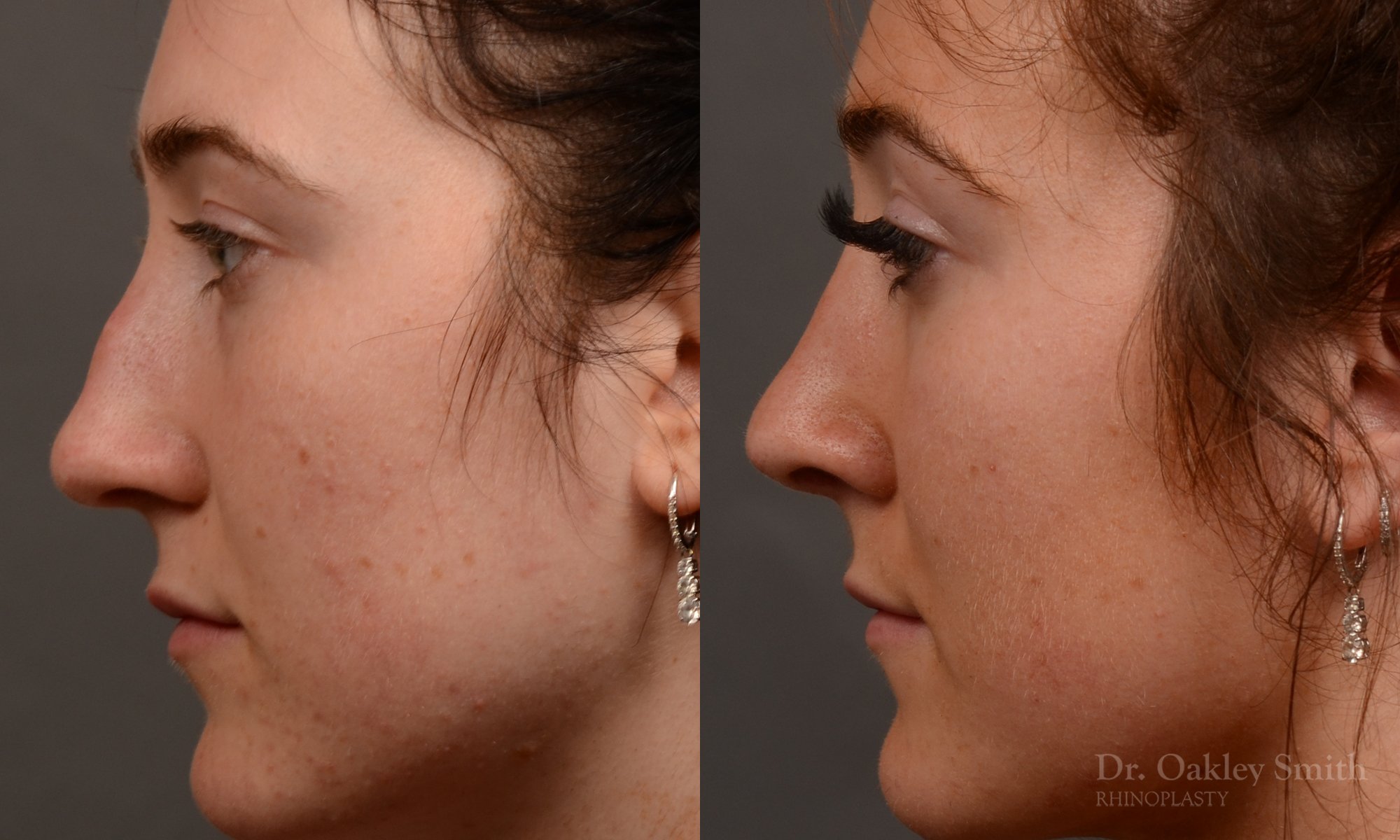 Rhinoplasty, Septoplasty - Rhinoplasty Before and After – Case 484