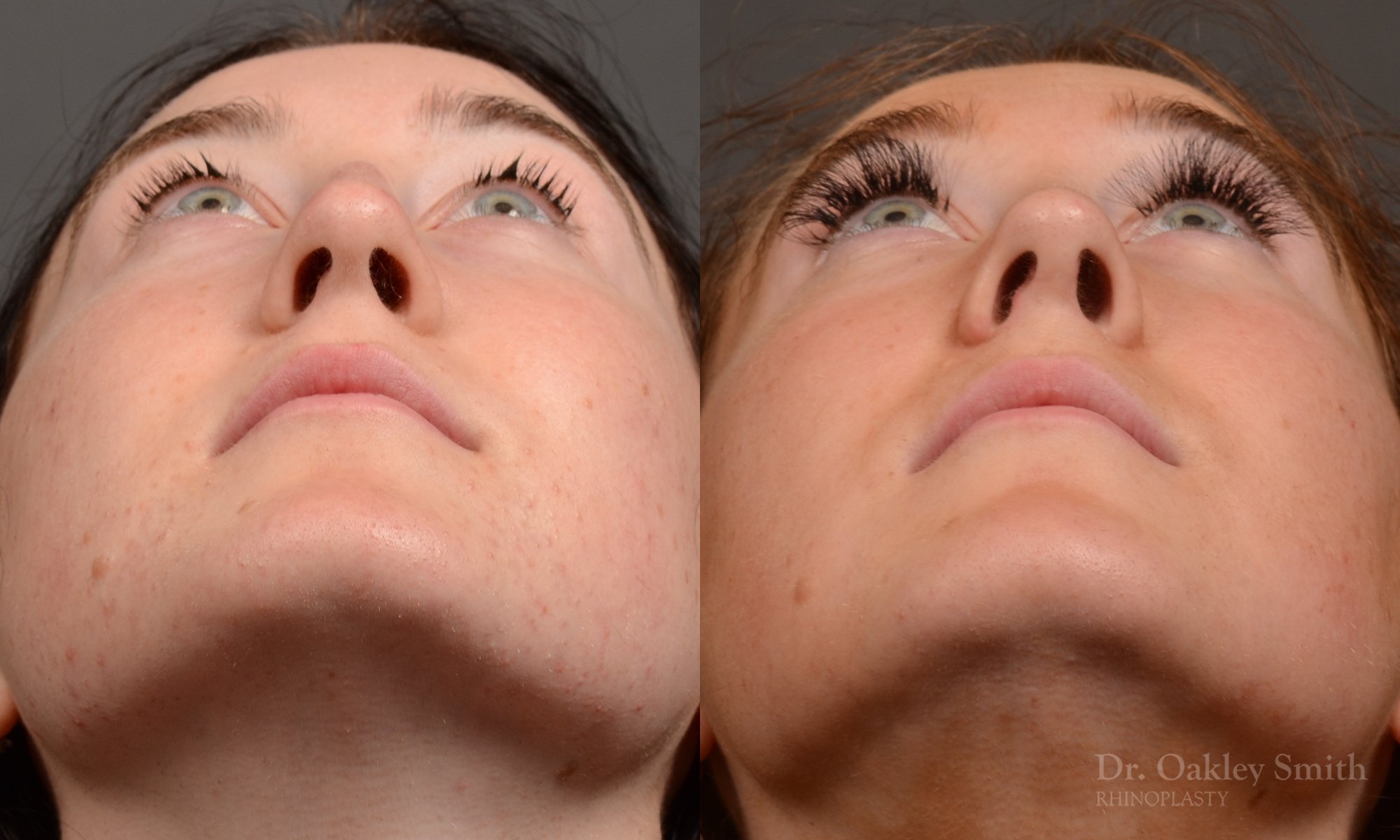 Rhinoplasty, Septoplasty - Rhinoplasty Before and After – Case 484