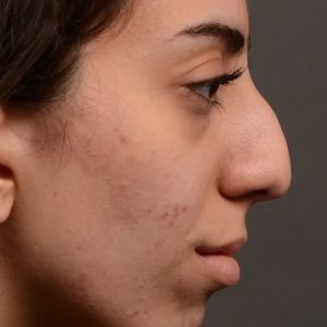 Rhinoplasty, Septoplasty - Rhinoplasty Before After Case 485