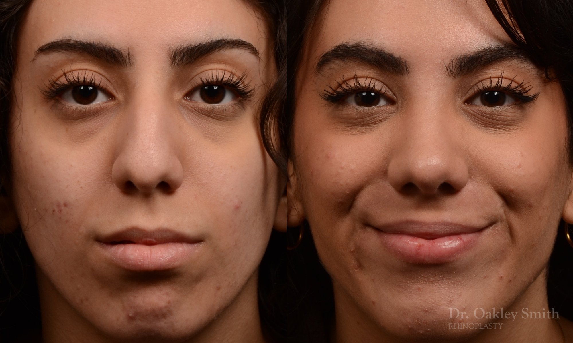 Rhinoplasty, Septoplasty - Rhinoplasty Before After Case 485