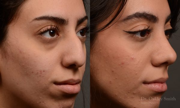 Rhinoplasty, Septoplasty - Rhinoplasty Before After Case 485