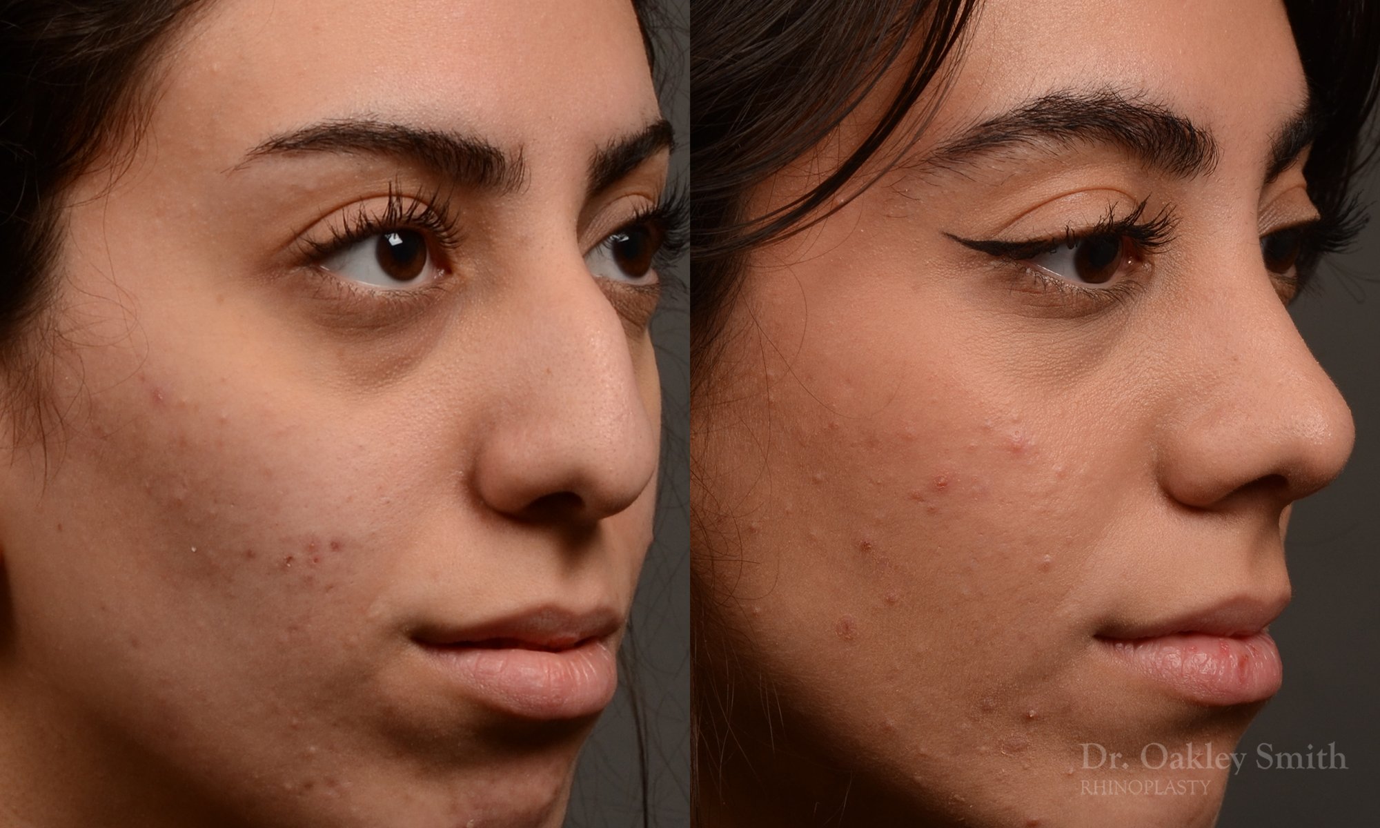 Rhinoplasty, Septoplasty - Rhinoplasty Before After Case 485
