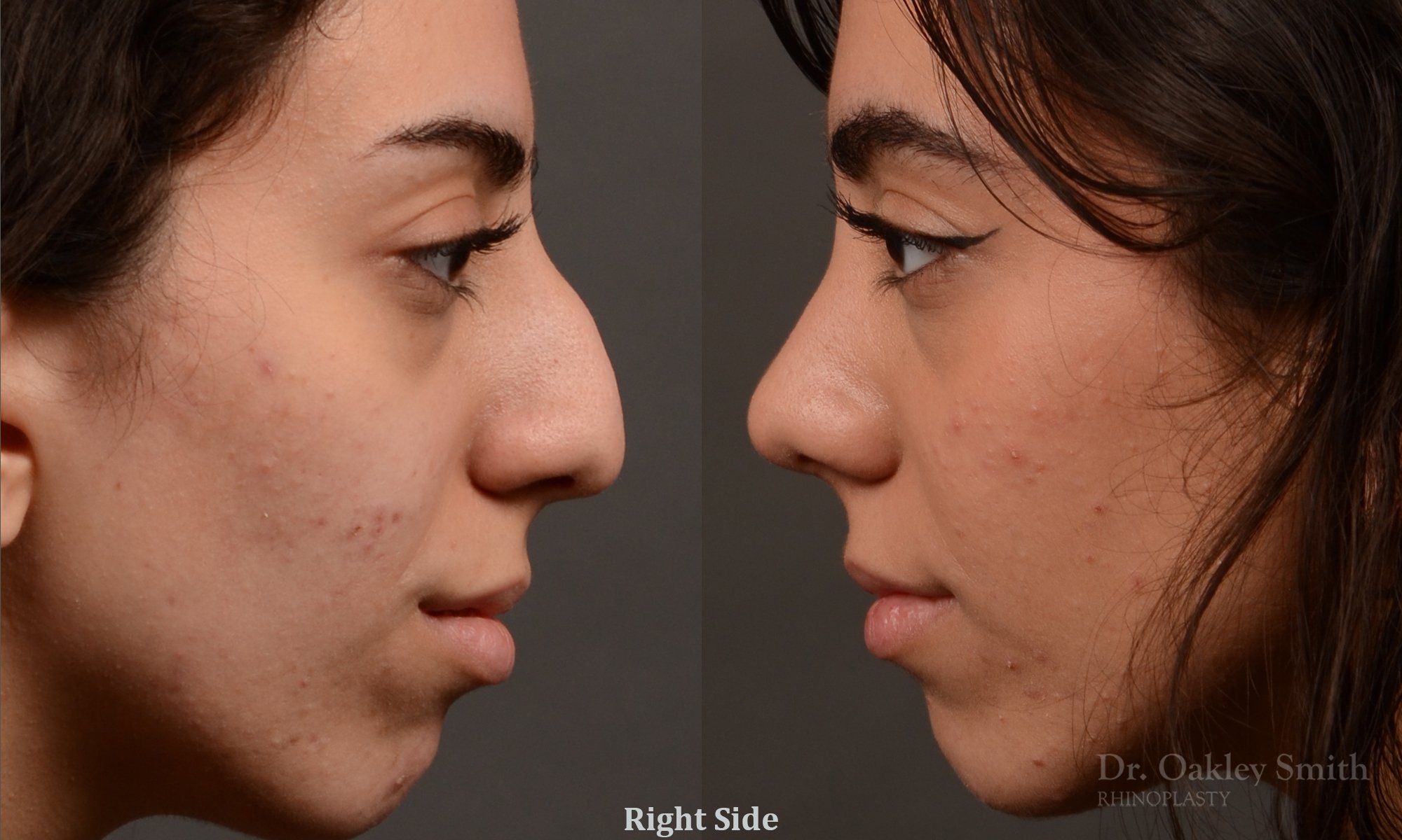 Rhinoplasty, Septoplasty - Rhinoplasty Before After Case 485