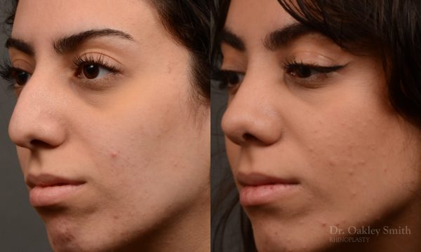 Rhinoplasty, Septoplasty - Rhinoplasty Before After Case 485