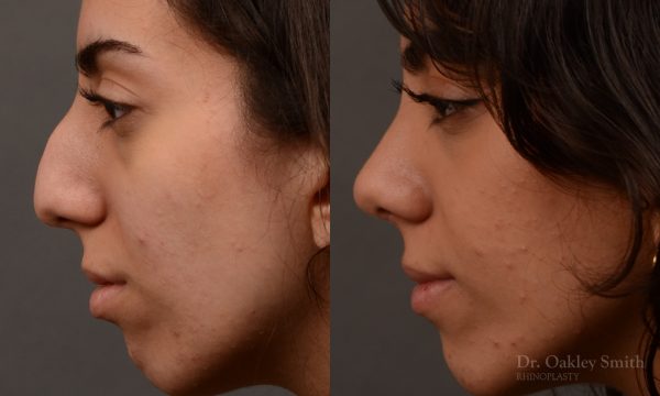 Rhinoplasty, Septoplasty - Rhinoplasty Before After Case 485
