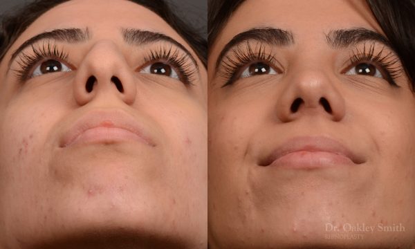 Rhinoplasty, Septoplasty - Rhinoplasty Before After Case 485