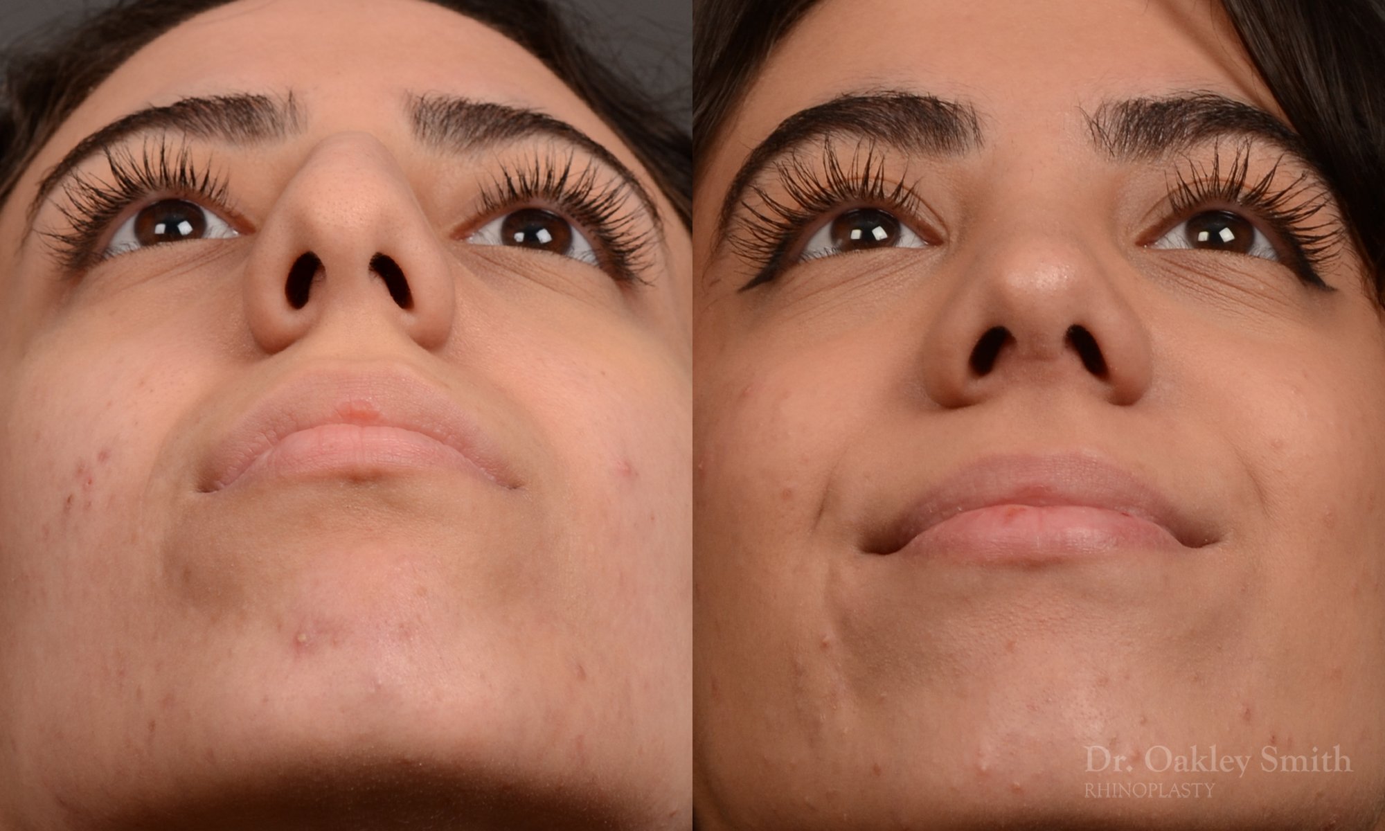 Rhinoplasty, Septoplasty - Rhinoplasty Before After Case 485