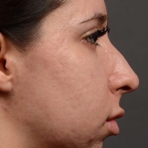 Rhinoplasty, Septoplasty - Rhinoplasty Before and After Case 486
