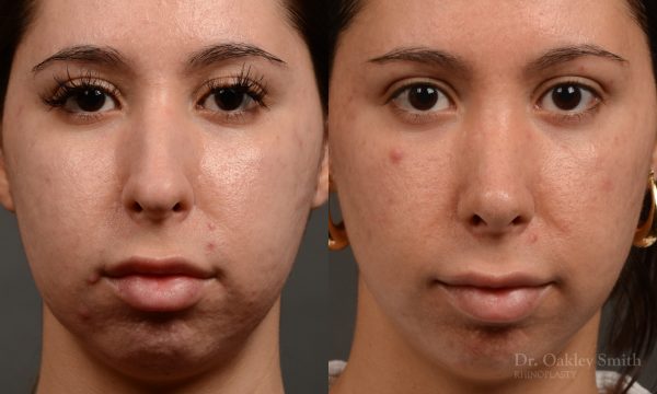 Rhinoplasty, Septoplasty - Rhinoplasty Before and After Case 486