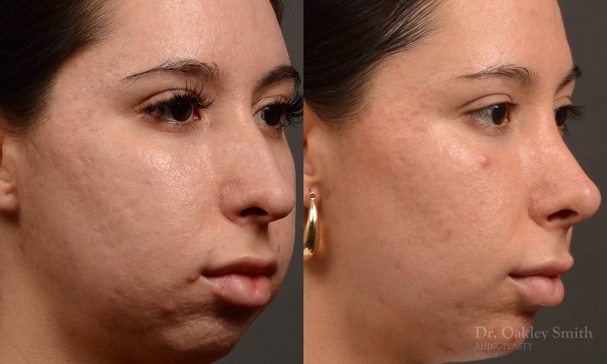 Rhinoplasty, Septoplasty - Rhinoplasty Before and After Case 486