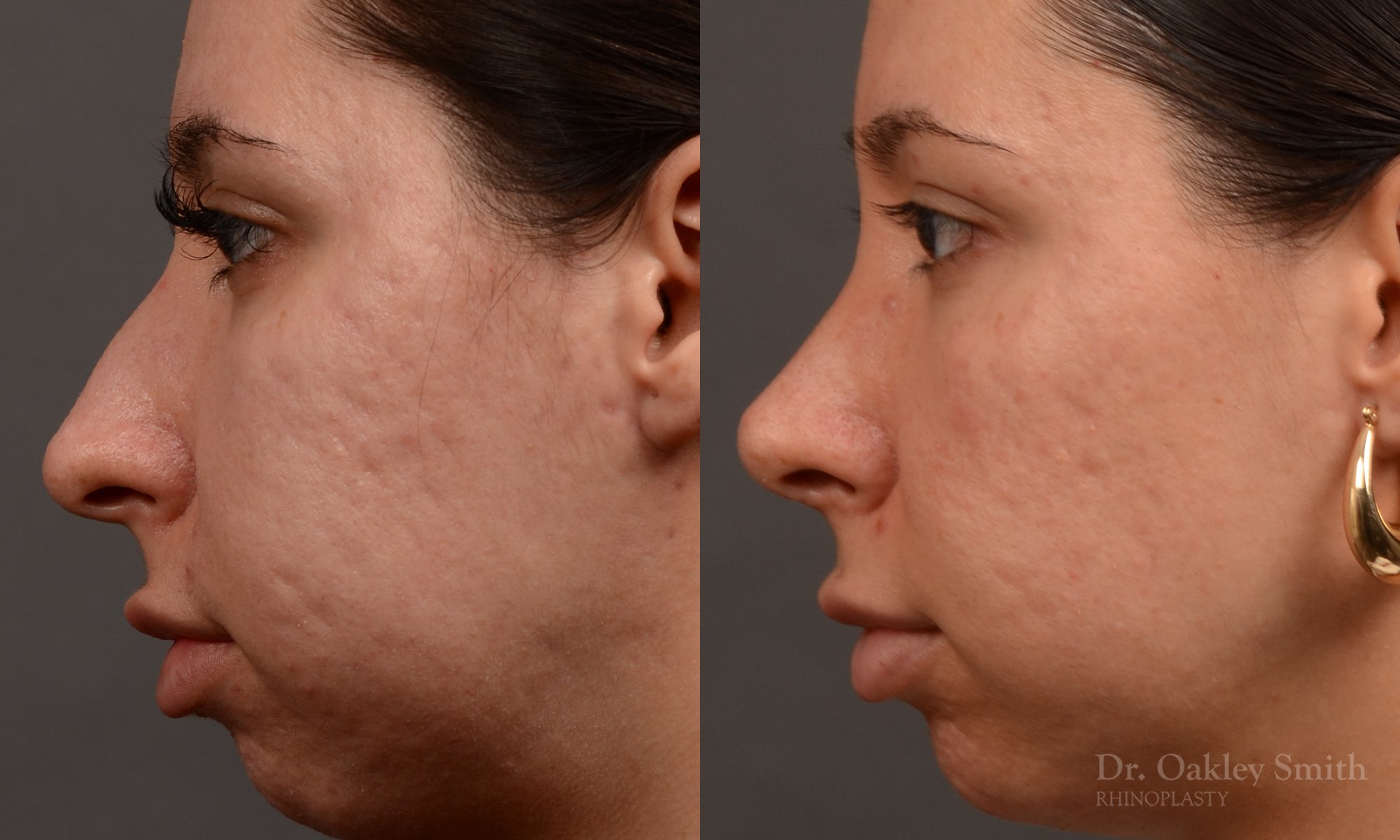 Rhinoplasty, Septoplasty - Rhinoplasty Before and After Case 486