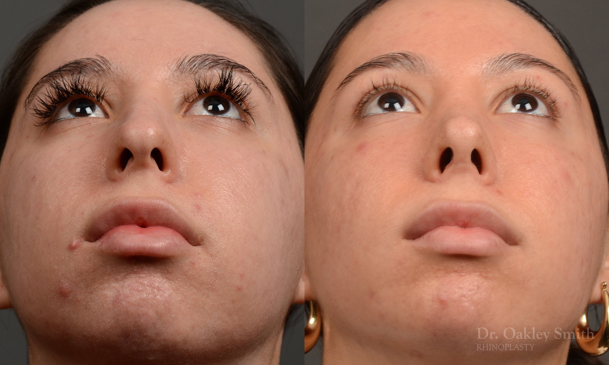 Rhinoplasty, Septoplasty - Rhinoplasty Before and After Case 486