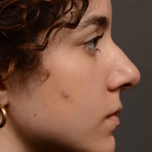 Rhinoplasty - Rhinoplasty Before and After – Case 487