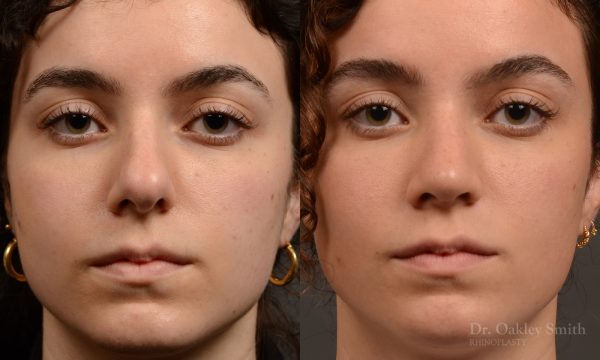 Rhinoplasty - Rhinoplasty Before and After – Case 487