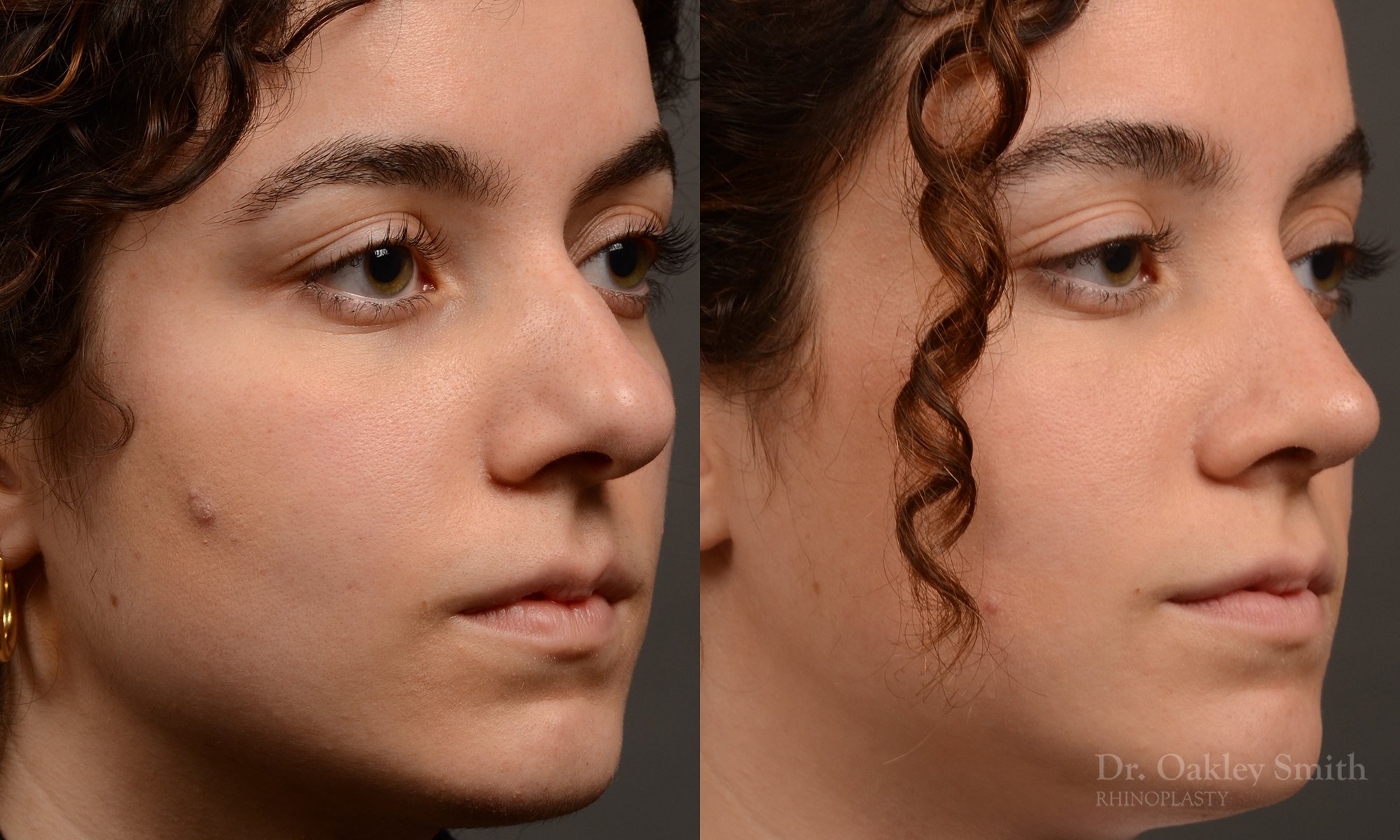 Rhinoplasty - Rhinoplasty Before and After – Case 487