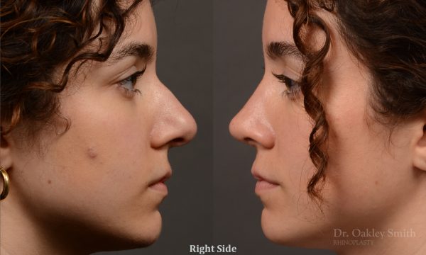 Rhinoplasty - Rhinoplasty Before and After – Case 487