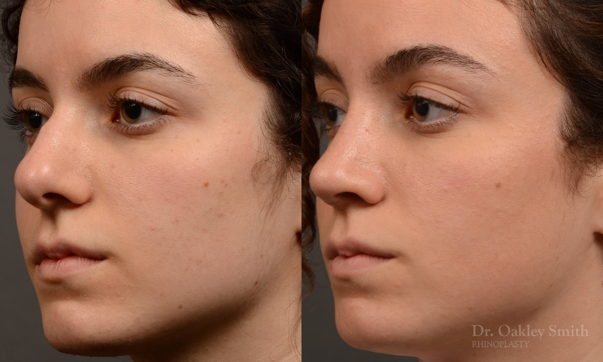 Rhinoplasty - Rhinoplasty Before and After – Case 487