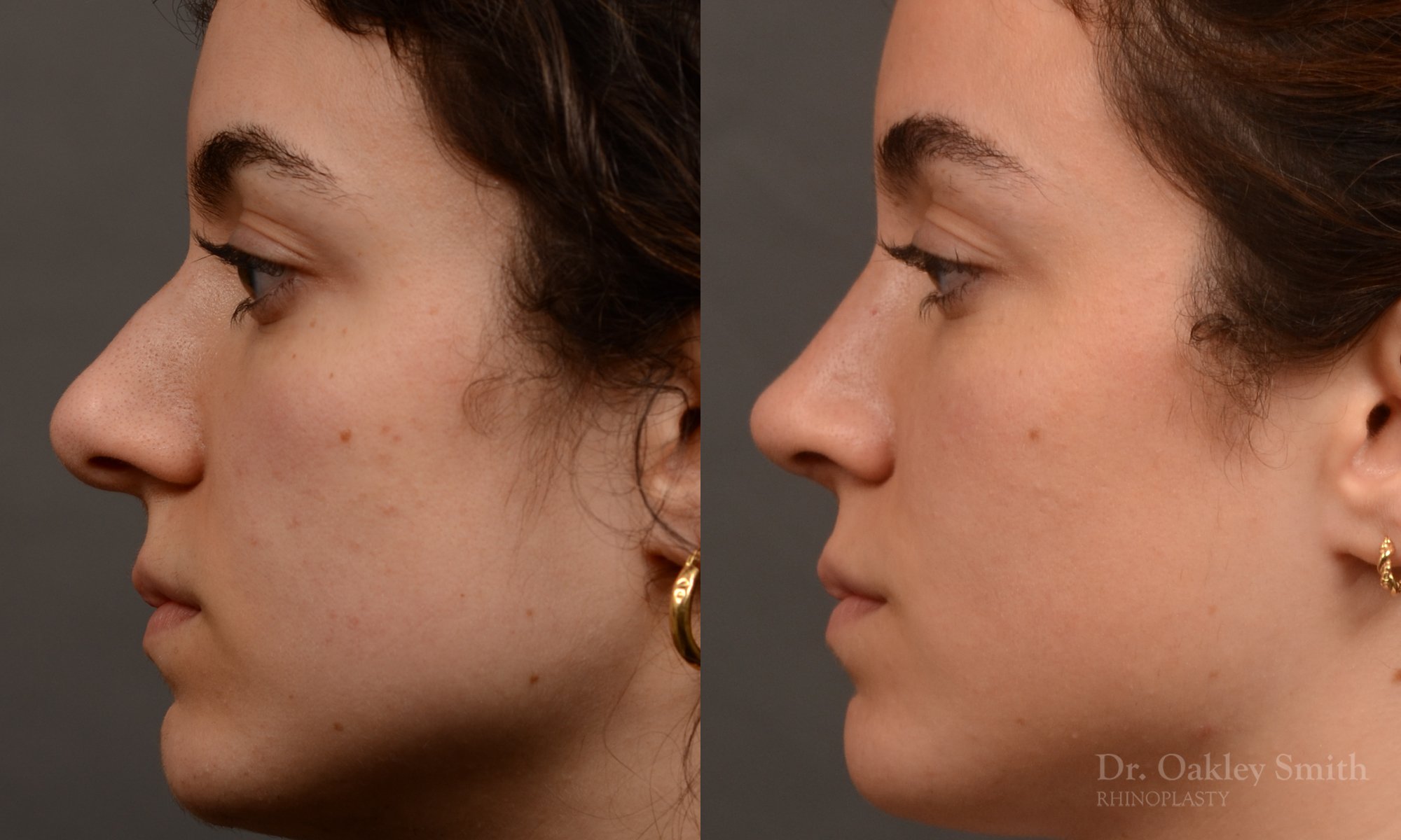 Rhinoplasty - Rhinoplasty Before and After – Case 487