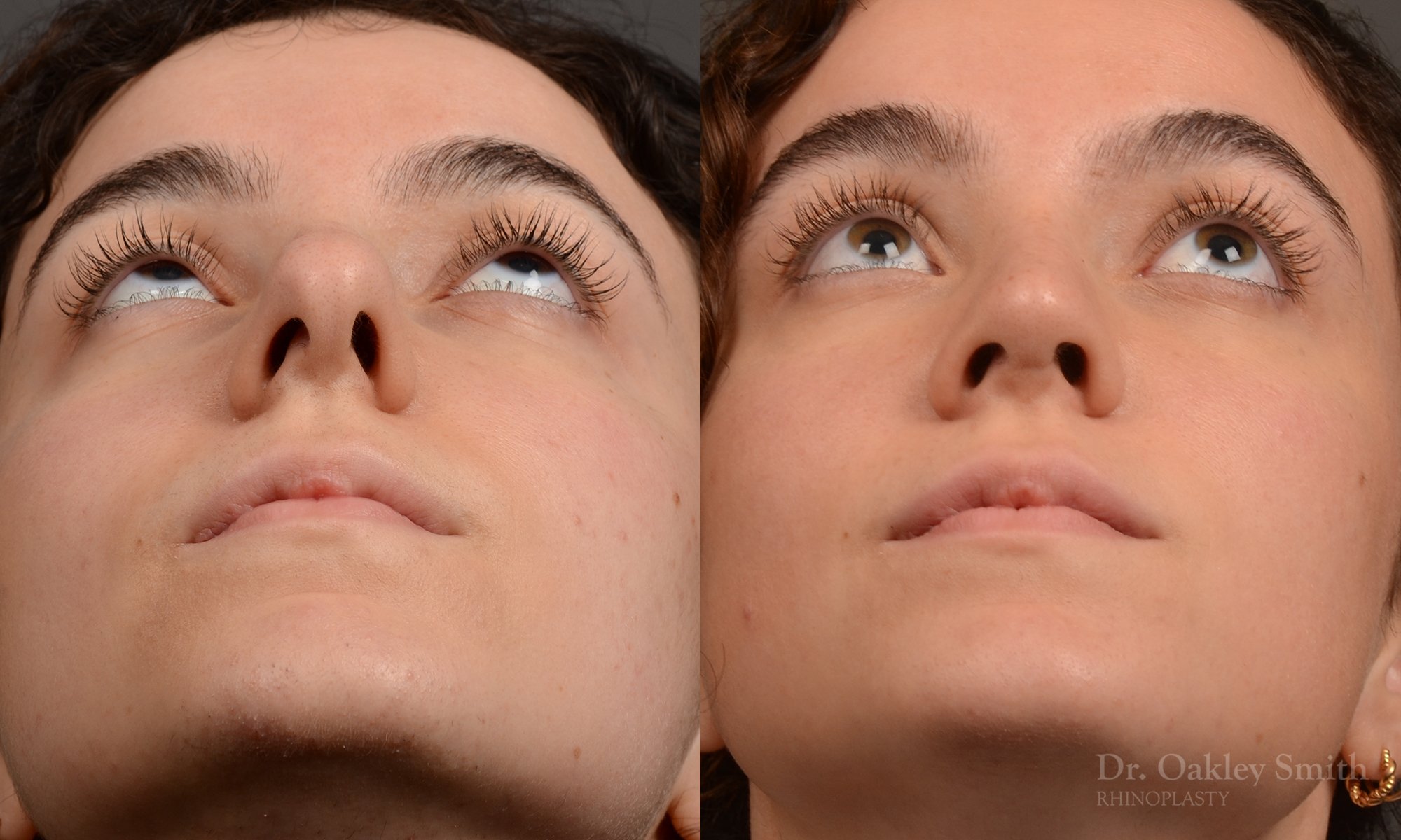Rhinoplasty - Rhinoplasty Before and After – Case 487