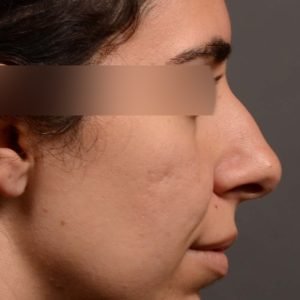 Rhinoplasty, Septoplasty - Rhinoplasty & Closed Septoplasty Before and After – Case 488