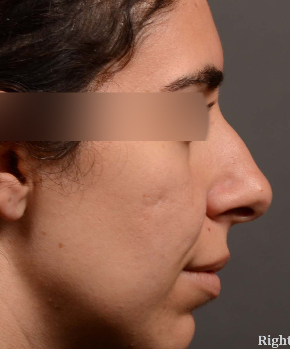 Rhinoplasty & Closed Septoplasty Before and After - Case 488