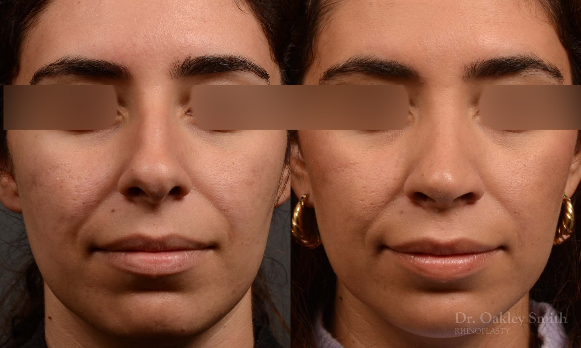 Rhinoplasty, Septoplasty - Rhinoplasty & Closed Septoplasty Before and After – Case 488