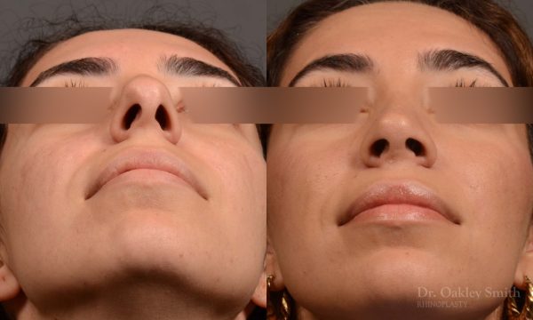 Rhinoplasty, Septoplasty - Rhinoplasty & Closed Septoplasty Before and After – Case 488