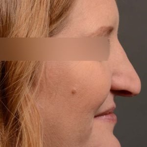 Rhinoplasty - Rhinoplasty Before and After – Case 489