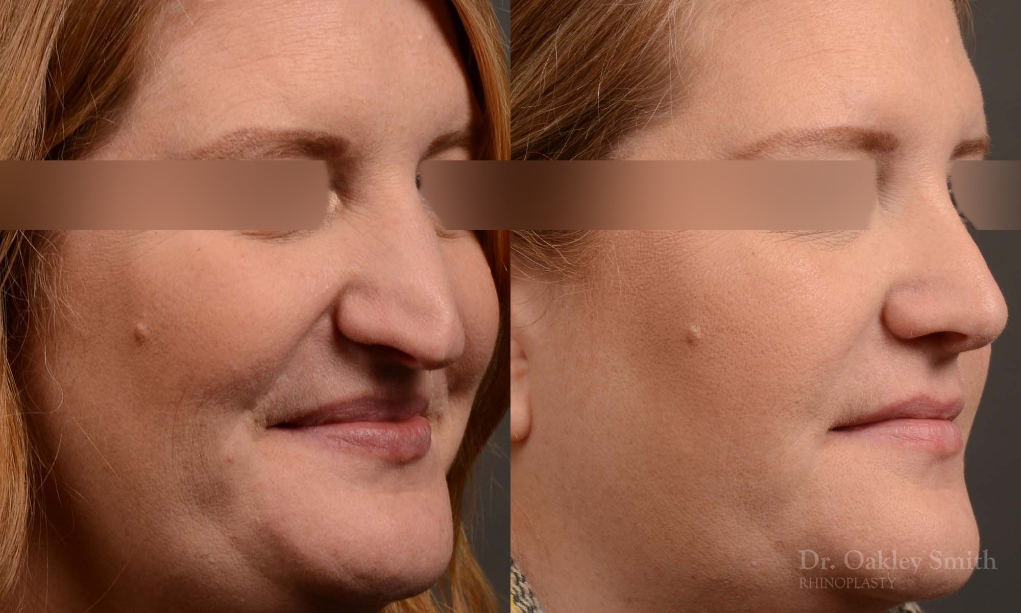 Rhinoplasty - Rhinoplasty Before and After – Case 489