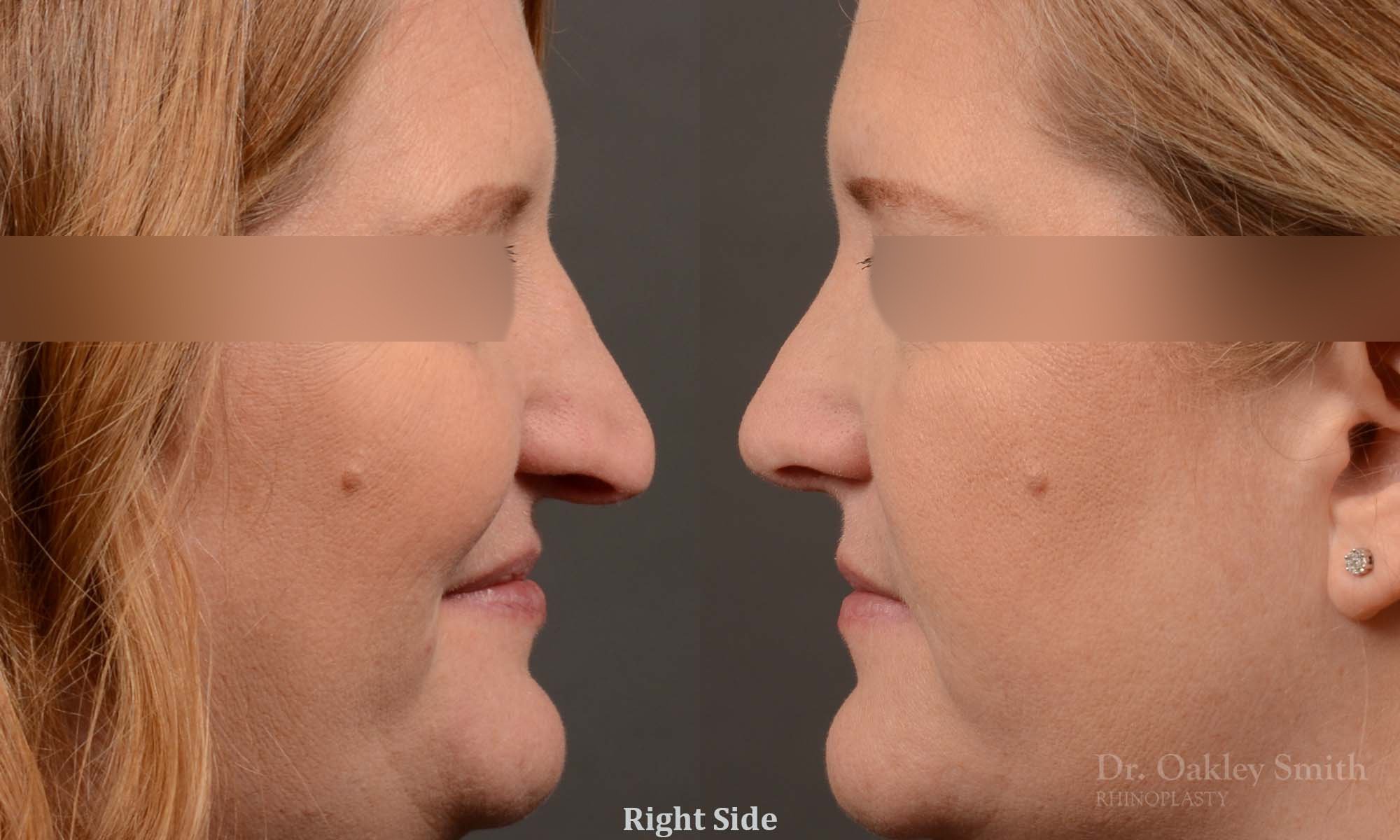Rhinoplasty - Rhinoplasty Before and After – Case 489