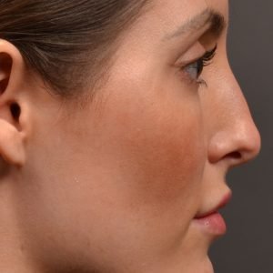 Rhinoplasty, Septoplasty - Rhinoplasty Before and After – Case 490