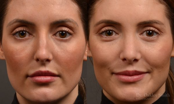 Rhinoplasty, Septoplasty - Rhinoplasty Before and After – Case 490