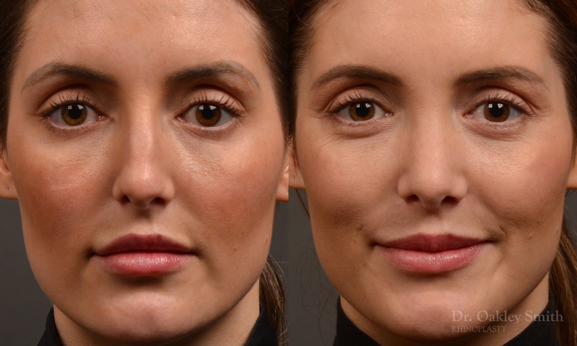 Rhinoplasty, Septoplasty - Rhinoplasty Before and After – Case 490