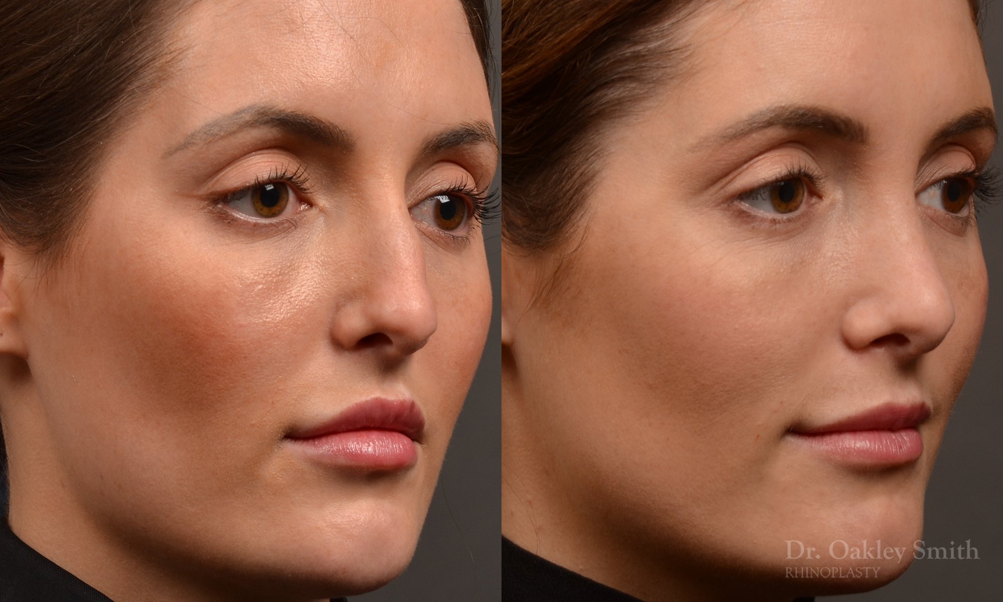 Rhinoplasty, Septoplasty - Rhinoplasty Before and After – Case 490